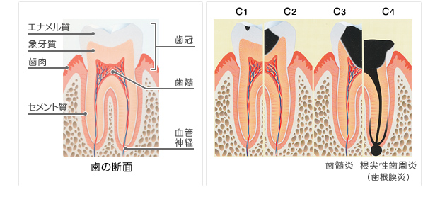 歯の断面・虫歯進行度