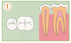1.初期の虫歯（C1〜C2）