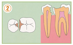 2.重症化虫歯（C3〜C4）