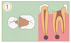 1.重症化虫歯（C3〜C4）